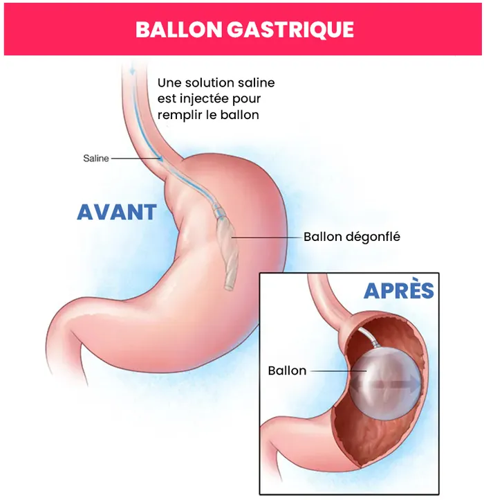 Ballon gastrique Turquie