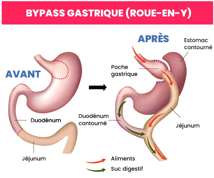 Bypass gastrique Turquie